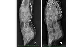 These X-rays illustrate vasoconstriction in cattle, comparing normal blood flow, left, to restricted blood flow, right, caused by ingestion of toxic fall fescue.